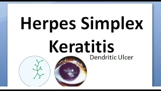 Ophthalmology 116 Herpes Simplex Keratitis Virus Cornea Dendritic HSV Wessley NeuroTrophic Disciform