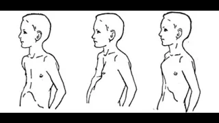 31. Аномалії розвитку кісток тулуба - AnatomUa_AUDIO