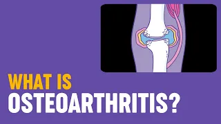 What is osteoarthritis?