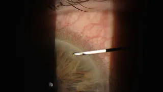 Removal of corneal foreign body - plant material!