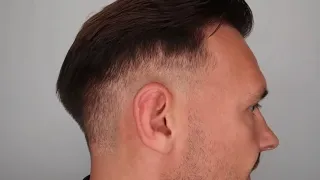 Kann ich die Seiten nach der Haartransplantation kurz oder auf null rasieren ?