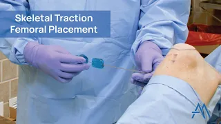Skeletal Traction - Femoral Placement
