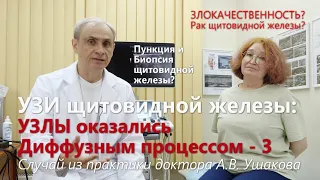 УЗИ щитовидной: Узлы оказались Диффузным процессом, Пункция и Биопсия были не нужны // Доктор Ушаков