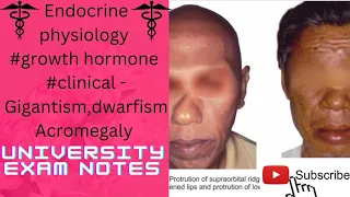 Growth hormone clinical/gigantism/acromegaly/dwarfism(@medicoscontent3135 )