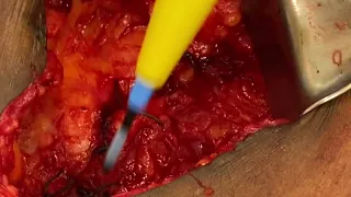 Anatomic ventral hernia repair