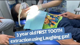 3 Year Old Toddler first tooth extraction | Kids Dentist | Laughing gas sedation | Kids Dental