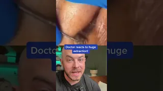 Doctor reacts to MASSIVE extraction! #dermreacts #doctorreacts #pimplepop