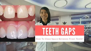 #GAPS BETWEEN TEETH? - FAST AND CHEAP WAYS TO CLOSE GAPS WITHOUT BRACES - Cosmetic Dentistry