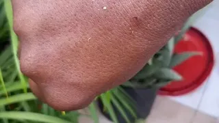 How to remove bee sting