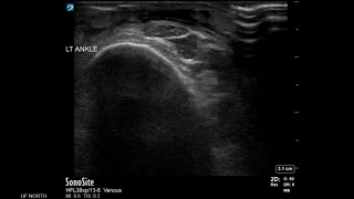 Leg Ultrasound: Pretibial Cellulitis