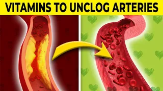 Top 7 Vitamins to Unclog Arteries