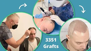 Kurzfilm: Haartransplantation in der Türkei [Dokumentation 2021]