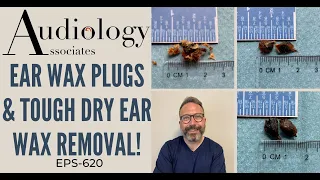 EAR WAX PLUGS & TOUGH DRY EAR WAX REMOVAL - EP620