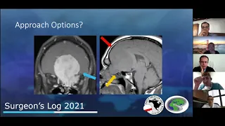 S2E9: The Anniversary Episode (Olfactory Groove meningioma)