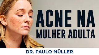 Acne na Mulher Adulta - Dr. Paulo Müller Dermatologista.