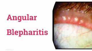 Angular blepharitis
