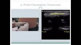 Ultrasound Guided Lumbar Puncture