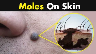 What Causes Moles in our skin? (3D Animation)