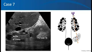 Renal ultrasound video 4, University of Florida Nephrology, by Dr. Koratala (Twitter: @NephroP)