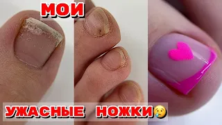 МОИ УЖАСНЫЕ НОЖКИ 😐 Педикюр на себе 🦶 Вычищаем подногтевую мозоль