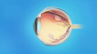Retinal Detachment animation
