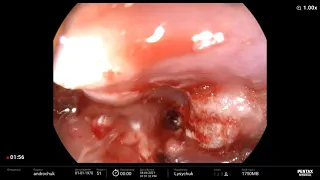 Esophageal cancer/ аденокарцинома пищевода