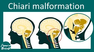 Chiari Malformation and Treatment | Type I and II Chiari malformation