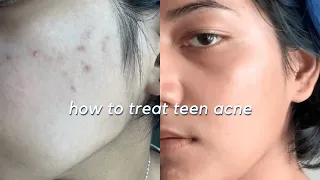 HOW TO TREAT TEEN ACNE 🧖‍♀️🧴✨Tips and Affordable Skincare Products for teens :)
