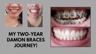 Comprehensive Damon Braces Video (Full Two-Year Process w/ Updates)