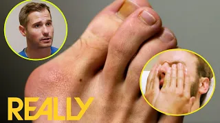 Massive Bunion Made Right Foot Three Sizes Bigger! | My Feet Are Killing Me