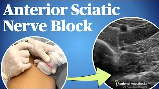 Ultrasound-Guided Anterior Sciatic Nerve Block