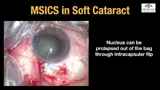 Management of Soft Cataract