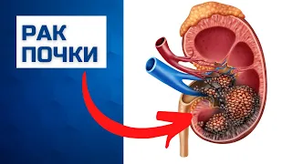 Рак почки симптомы, диагностика и лечение без операции