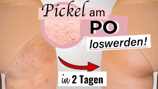 SCHNELL Pickel am Po loswerden! 🍑 💯