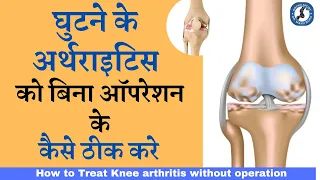 घुटने के #Arthritis को बिना ऑपरेशन के कैसे ठीक करे, How to Treat Knee Arthritis without Surgery