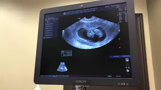 11 Week Ultrasound- Very Active Baby