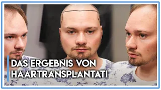Das Ergebnis von Haartransplantation nach 8 Monaten ( 2019 BEFORE&AFTER ) #hair transplant #hairloss