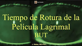 Tiempo de Rotura de la Película Lagrimal. Break Up Time (BUT).