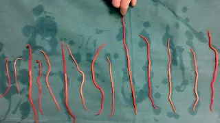 Doctors Remove 14 Roundworms From Woman