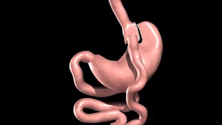 Laparoscopic Gastric Bypass Animation