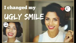 How to IMPROVE AWKWARD SMILE into PICTURE PERFECT Smile/ Without Dentist/ GIVEAWAY