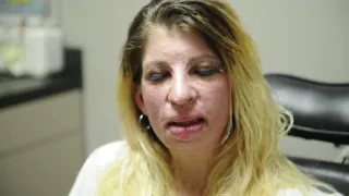 Nashville doctor treats scars on former meth addict