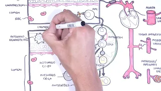 Vasculitis Pathophysiology Overview