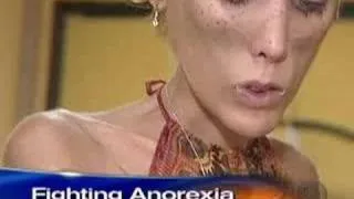 Anorexia's Childhood Roots (CBS News)