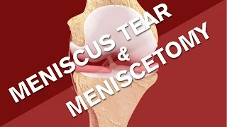 What is a meniscus tear?