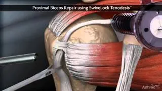 Тенодез сухожилия длинной головки бицепса (Proximal Biceps Repair using SwiveLock Tenodesis)