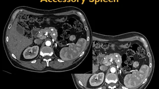 CT Evaluation of the Spleen: Challenges in Diagnosis Part 1