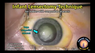 CataractCoach 1101: infant lensectomy for baby with congenital cataracts