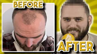 Stevie Reveals His BRAND NEW HAIR After Transplant!