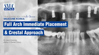 [SNUCONE IMPLANT] Full Arch Immediate Placement & Crestal Approach